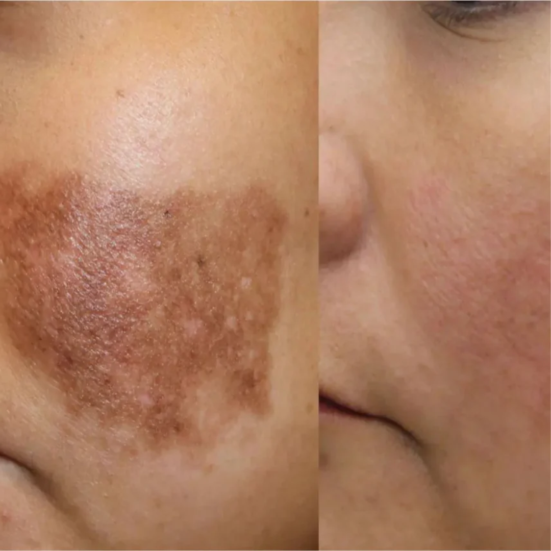 Advanced Pigmentation & Acne Herbal Face Serum - Sillima