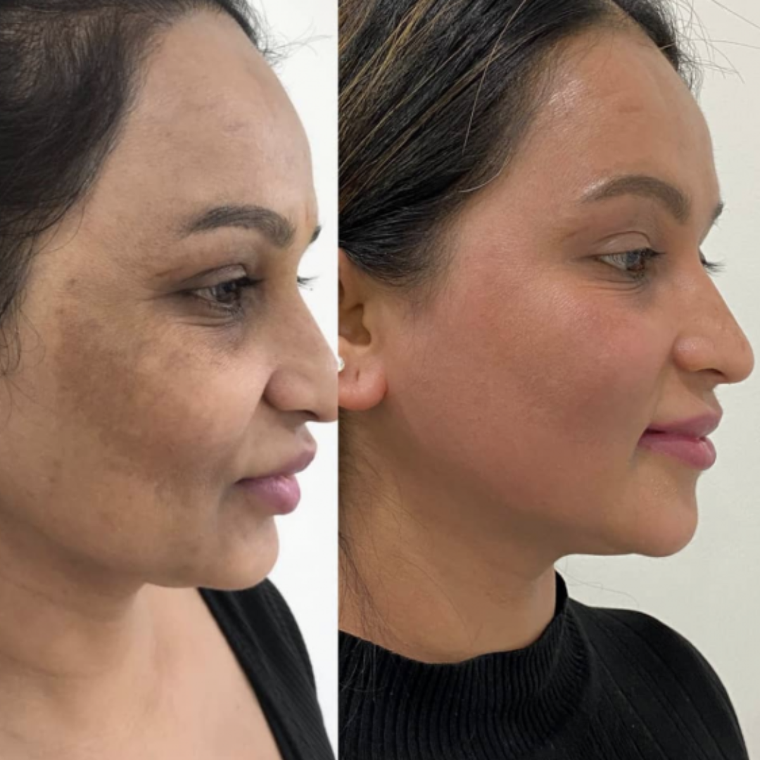 Advanced Pigmentation & Acne Herbal Face Serum - Sillima