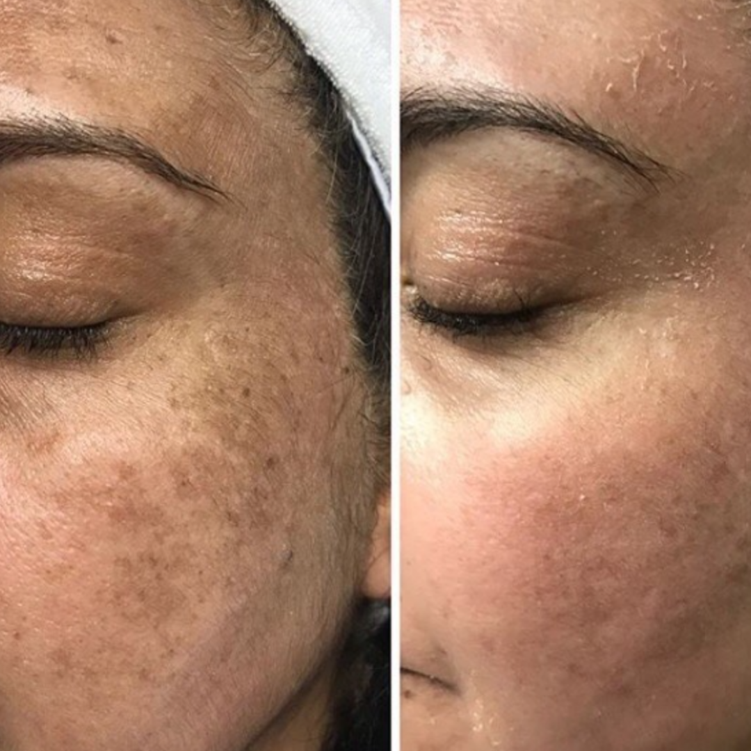 Advanced Pigmentation & Acne Herbal Face Serum - Sillima