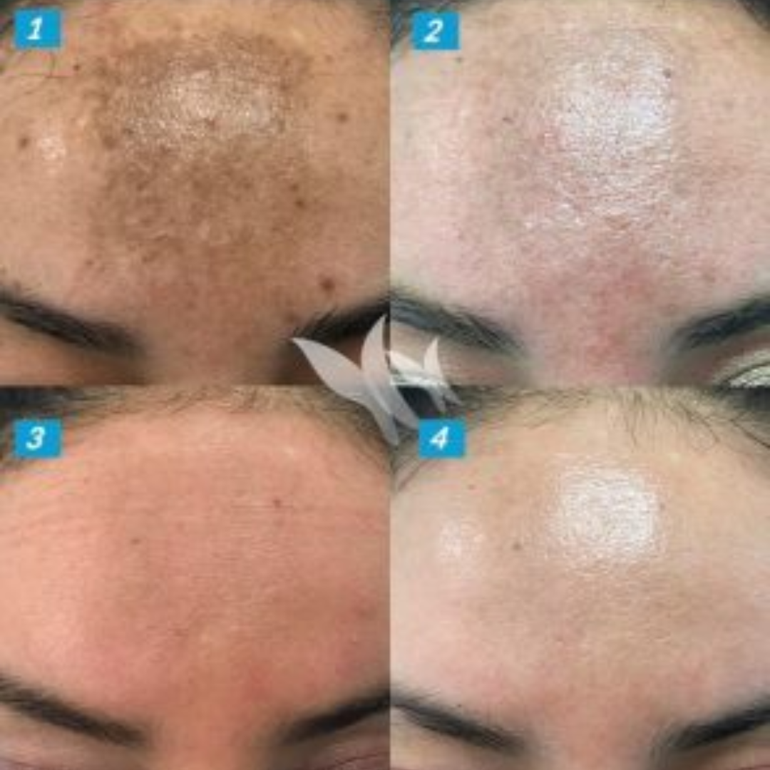Advanced Pigmentation & Acne Herbal Face Serum - Sillima