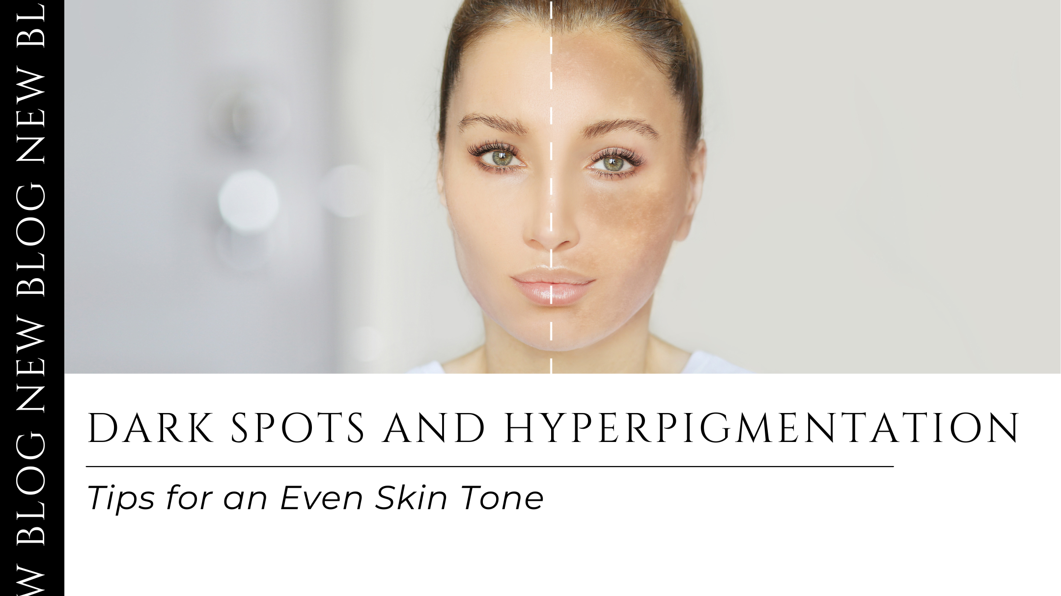 Dark Spots and Hyperpigmentation: Tips for an Even Skin Tone – Sillima