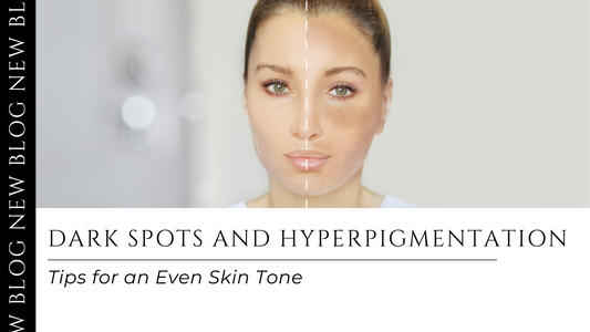 Blog post image titled 'Dark Spots and Hyperpigmentation,' featuring a woman's face split to show uneven skin tone. Offers tips for achieving an even complexion